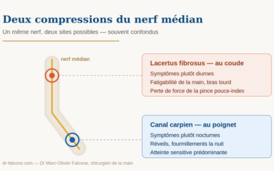 Syndrome du lacertus fibrosus : symptômes, diagnostic, traitement