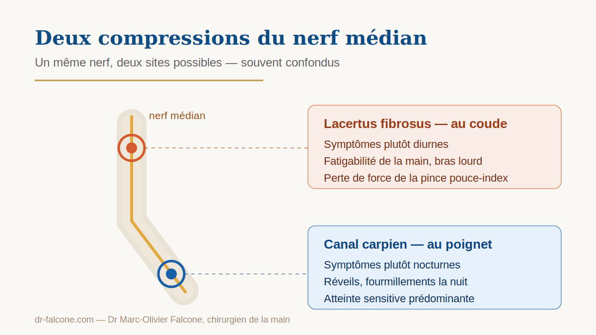 Schéma comparant le syndrome du lacertus fibrosus au coude et le syndrome du canal carpien au poignet, deux compressions du nerf médian