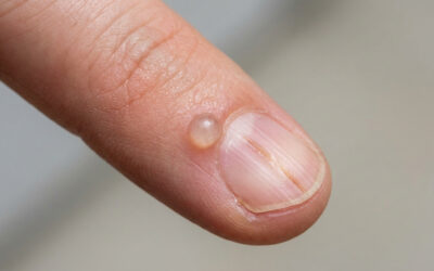 Kyste mucoïde du doigt et ongle : comprendre la déformation