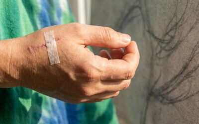 Tabac et cicatrisation après chirurgie de la main